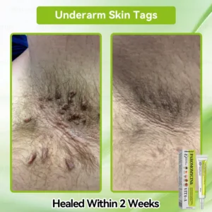 ✨✨𝐺𝑙𝑖𝑚𝑚𝑒𝑟𝑙𝑦® 𝑃𝑎𝑟𝑜𝑚𝑜𝑚𝑦𝑐𝑖𝑛 & 𝑉𝑖𝑡𝑎-𝑎 𝑅𝑒𝑡𝑖𝑛𝑜𝑙 𝑆ℎ𝑜𝑡 𝑆𝑘𝑖𝑛 𝑅𝑒𝑝𝑎𝑖𝑟 𝐶𝑟𝑒𝑎𝑚（𝐖𝐢𝐭𝐡 𝐋𝐢𝐪𝐮𝐢𝐝 𝐌𝐢𝐜𝐫𝐨𝐧𝐞𝐞𝐝𝐥𝐞𝐬, 𝐆𝐞𝐧𝐭𝐥𝐲 𝐆𝐞𝐭𝐬 𝐑𝐢𝐝 𝐎𝐟 𝐖𝐚𝐫𝐭𝐬, 𝐌𝐨𝐥𝐞𝐬, 𝐀𝐠𝐞 𝐒𝐩𝐨𝐭𝐬, 𝐀𝐧𝐝 𝐒𝐤𝐢𝐧 𝐓𝐚𝐠𝐬 ）