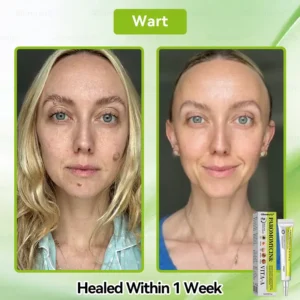 ✨✨𝐺𝑙𝑖𝑚𝑚𝑒𝑟𝑙𝑦® 𝑃𝑎𝑟𝑜𝑚𝑜𝑚𝑦𝑐𝑖𝑛 & 𝑉𝑖𝑡𝑎-𝑎 𝑅𝑒𝑡𝑖𝑛𝑜𝑙 𝑆ℎ𝑜𝑡 𝑆𝑘𝑖𝑛 𝑅𝑒𝑝𝑎𝑖𝑟 𝐶𝑟𝑒𝑎𝑚（𝐖𝐢𝐭𝐡 𝐋𝐢𝐪𝐮𝐢𝐝 𝐌𝐢𝐜𝐫𝐨𝐧𝐞𝐞𝐝𝐥𝐞𝐬, 𝐆𝐞𝐧𝐭𝐥𝐲 𝐆𝐞𝐭𝐬 𝐑𝐢𝐝 𝐎𝐟 𝐖𝐚𝐫𝐭𝐬, 𝐌𝐨𝐥𝐞𝐬, 𝐀𝐠𝐞 𝐒𝐩𝐨𝐭𝐬, 𝐀𝐧𝐝 𝐒𝐤𝐢𝐧 𝐓𝐚𝐠𝐬 ）