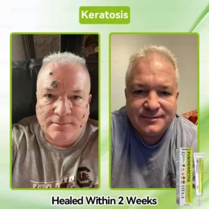 ✨✨𝐺𝑙𝑖𝑚𝑚𝑒𝑟𝑙𝑦® 𝑃𝑎𝑟𝑜𝑚𝑜𝑚𝑦𝑐𝑖𝑛 & 𝑉𝑖𝑡𝑎-𝑎 𝑅𝑒𝑡𝑖𝑛𝑜𝑙 𝑆ℎ𝑜𝑡 𝑆𝑘𝑖𝑛 𝑅𝑒𝑝𝑎𝑖𝑟 𝐶𝑟𝑒𝑎𝑚（𝐖𝐢𝐭𝐡 𝐋𝐢𝐪𝐮𝐢𝐝 𝐌𝐢𝐜𝐫𝐨𝐧𝐞𝐞𝐝𝐥𝐞𝐬, 𝐆𝐞𝐧𝐭𝐥𝐲 𝐆𝐞𝐭𝐬 𝐑𝐢𝐝 𝐎𝐟 𝐖𝐚𝐫𝐭𝐬, 𝐌𝐨𝐥𝐞𝐬, 𝐀𝐠𝐞 𝐒𝐩𝐨𝐭𝐬, 𝐀𝐧𝐝 𝐒𝐤𝐢𝐧 𝐓𝐚𝐠𝐬 ）