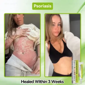 ✨✨𝐺𝑙𝑖𝑚𝑚𝑒𝑟𝑙𝑦® 𝑃𝑎𝑟𝑜𝑚𝑜𝑚𝑦𝑐𝑖𝑛 & 𝑉𝑖𝑡𝑎-𝑎 𝑅𝑒𝑡𝑖𝑛𝑜𝑙 𝑆ℎ𝑜𝑡 𝑆𝑘𝑖𝑛 𝑅𝑒𝑝𝑎𝑖𝑟 𝐶𝑟𝑒𝑎𝑚（𝐖𝐢𝐭𝐡 𝐋𝐢𝐪𝐮𝐢𝐝 𝐌𝐢𝐜𝐫𝐨𝐧𝐞𝐞𝐝𝐥𝐞𝐬, 𝐆𝐞𝐧𝐭𝐥𝐲 𝐆𝐞𝐭𝐬 𝐑𝐢𝐝 𝐎𝐟 𝐖𝐚𝐫𝐭𝐬, 𝐌𝐨𝐥𝐞𝐬, 𝐀𝐠𝐞 𝐒𝐩𝐨𝐭𝐬, 𝐀𝐧𝐝 𝐒𝐤𝐢𝐧 𝐓𝐚𝐠𝐬 ）