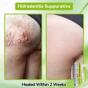 ✨✨𝐺𝑙𝑖𝑚𝑚𝑒𝑟𝑙𝑦® 𝑃𝑎𝑟𝑜𝑚𝑜𝑚𝑦𝑐𝑖𝑛 & 𝑉𝑖𝑡𝑎-𝑎 𝑅𝑒𝑡𝑖𝑛𝑜𝑙 𝑆ℎ𝑜𝑡 𝑆𝑘𝑖𝑛 𝑅𝑒𝑝𝑎𝑖𝑟 𝐶𝑟𝑒𝑎𝑚（𝐖𝐢𝐭𝐡 𝐋𝐢𝐪𝐮𝐢𝐝 𝐌𝐢𝐜𝐫𝐨𝐧𝐞𝐞𝐝𝐥𝐞𝐬, 𝐆𝐞𝐧𝐭𝐥𝐲 𝐆𝐞𝐭𝐬 𝐑𝐢𝐝 𝐎𝐟 𝐖𝐚𝐫𝐭𝐬, 𝐌𝐨𝐥𝐞𝐬, 𝐀𝐠𝐞 𝐒𝐩𝐨𝐭𝐬, 𝐀𝐧𝐝 𝐒𝐤𝐢𝐧 𝐓𝐚𝐠𝐬 ）