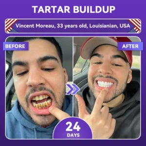 ✨👍𝐺𝑙𝑖𝑚𝑚𝑒𝑟𝑙𝑦® 𝐴𝑑𝑣𝑎𝑛𝑐𝑒𝑑 𝑃𝑢𝑟𝑝𝑙𝑒 𝑊ℎ𝑖𝑡𝑒𝑛𝑖𝑛𝑔 𝑆𝑡𝑟𝑖𝑝𝑠