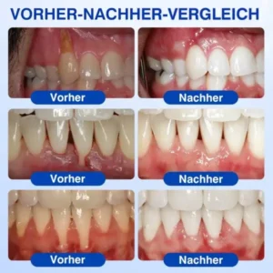 Glimmerly® GumRevive Parodontales Reparaturgel